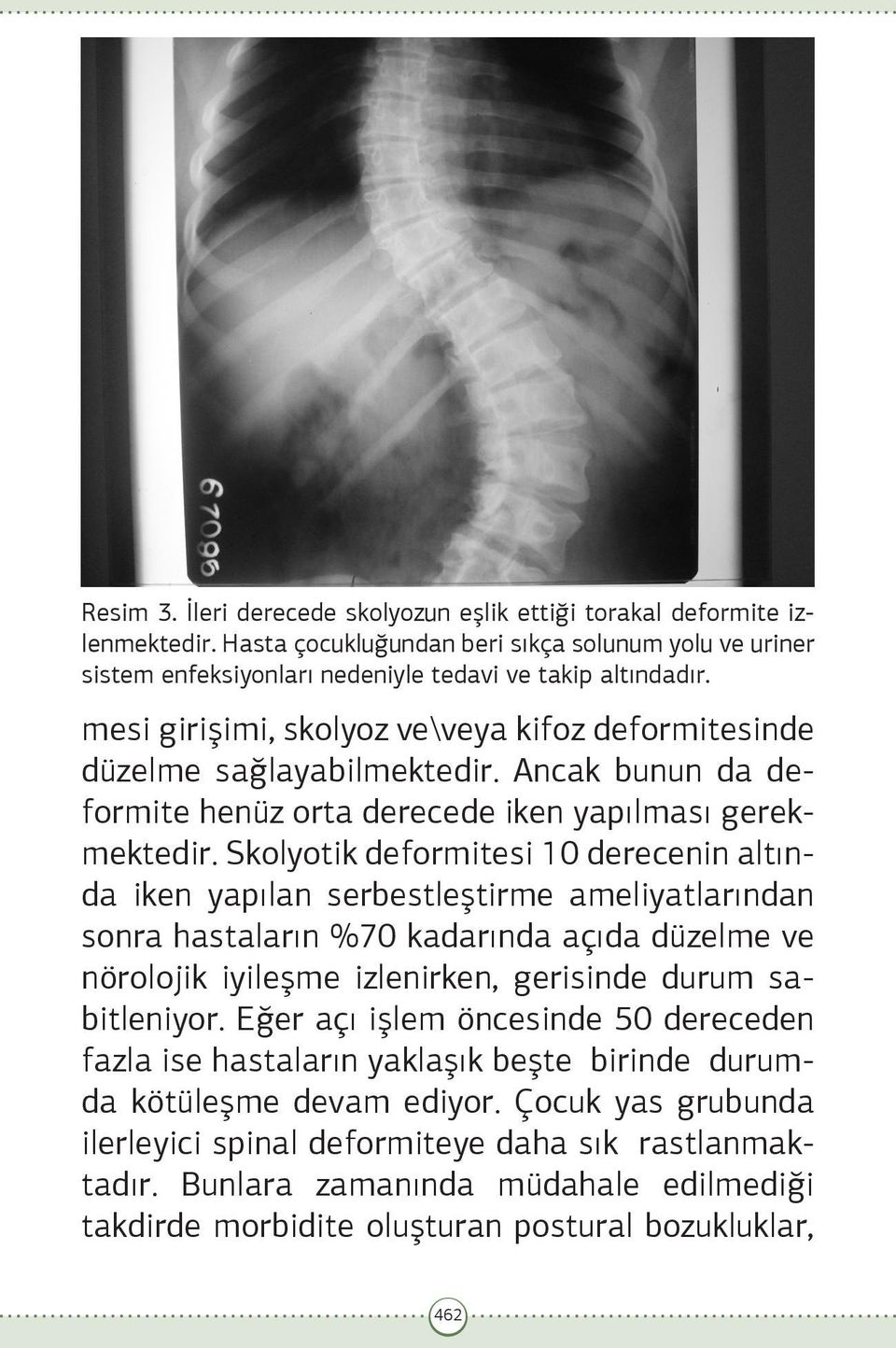 Skolyotik deformitesi 10 derecenin altında iken yapılan serbestleştirme ameliyatlarından sonra hastaların %70 kadarında açıda düzelme ve nörolojik iyileşme izlenirken, gerisinde durum sabitleniyor.