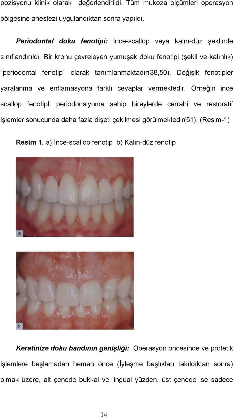 Örneğin ince scallop fenotipli periodonsiyuma sahip bireylerde cerrahi ve restoratif işlemler sonucunda daha fazla dişeti çekilmesi görülmektedir(51). (Resim-1) Resim 1.