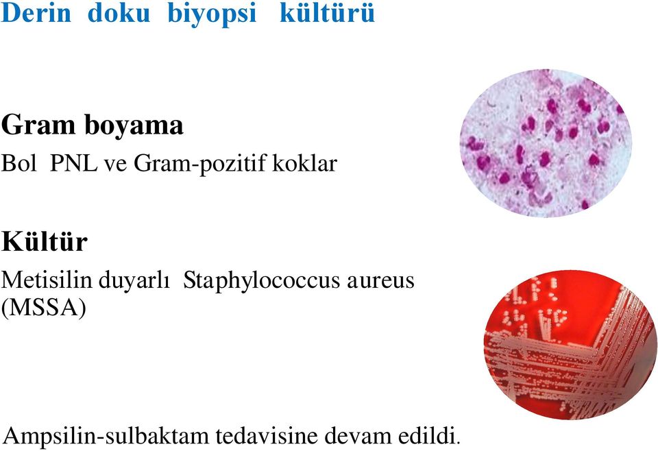 Metisilin duyarlı Staphylococcus aureus