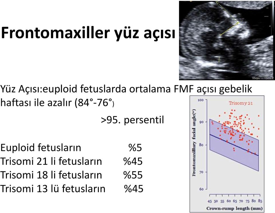 >95. persentil Euploid fetusların %5 Trisomi 21 li