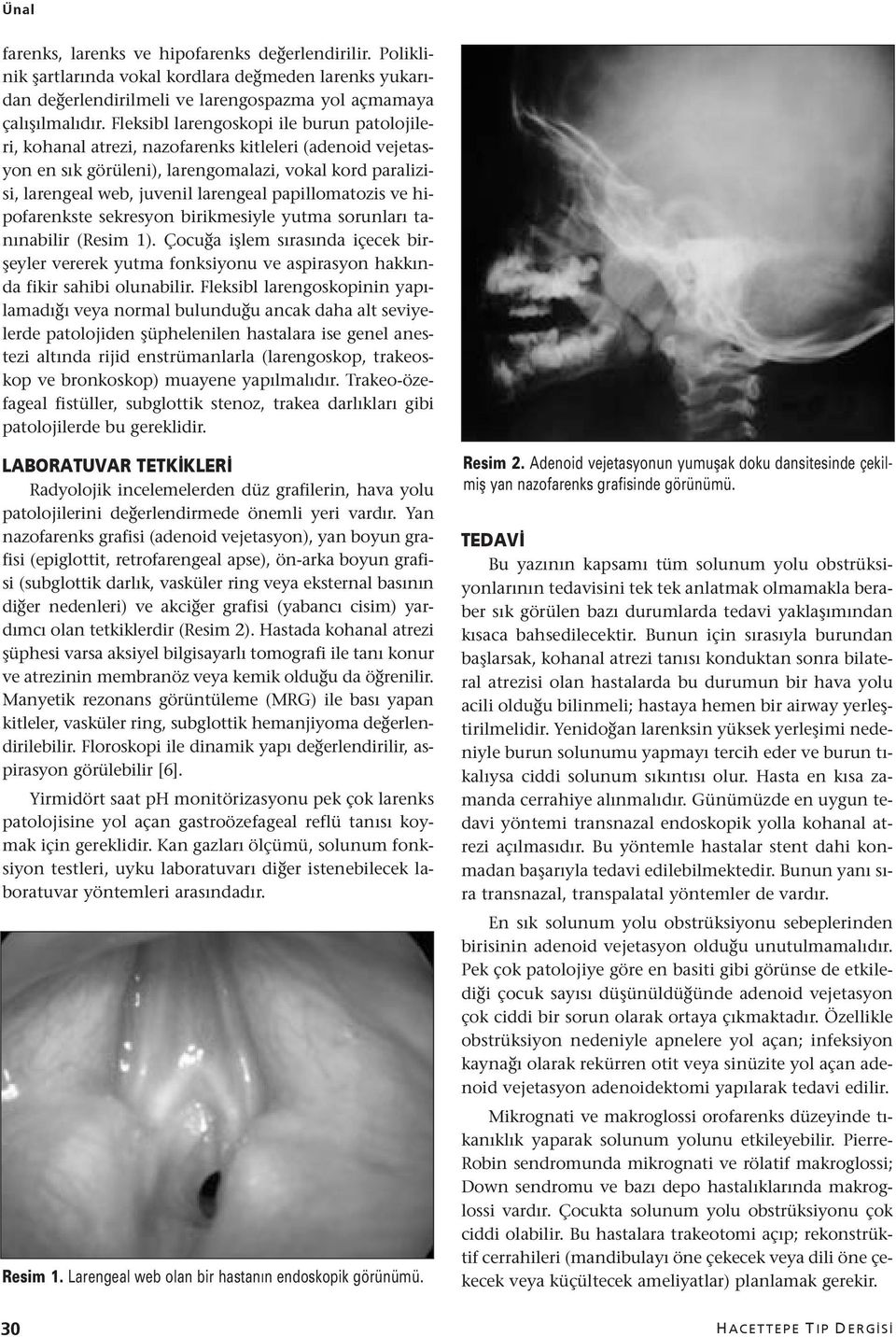 papillomatozis ve hipofarenkste sekresyon birikmesiyle yutma sorunları tanınabilir (Resim 1).