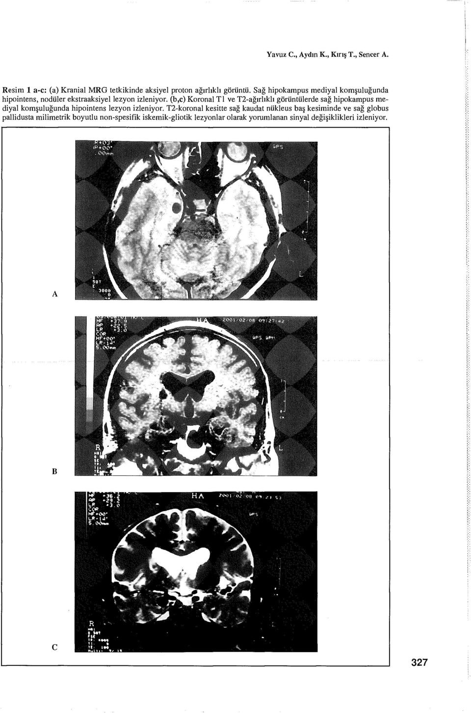 (b,c) Koronal Tl ve T2-ağırlıklı görüntülerde sağ hipokampus mediyal komşuluğunda hipointens lezyon izleniyor.