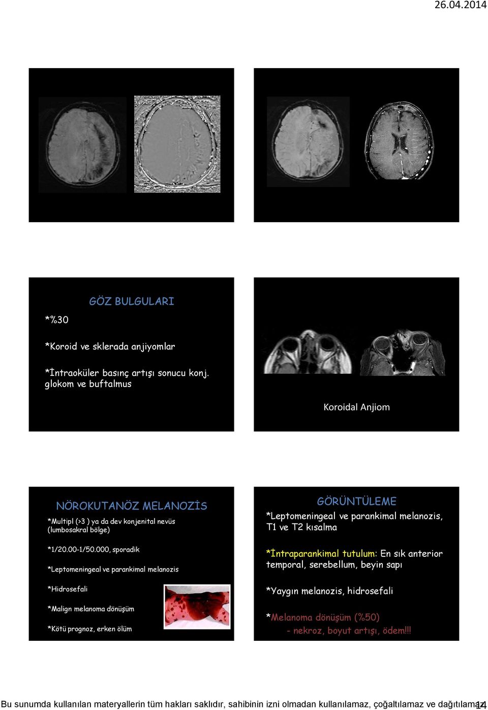 *Leptomeningeal ve parankimal melanozis, T1 ve T2 kısalma *1/20.00-1/50.