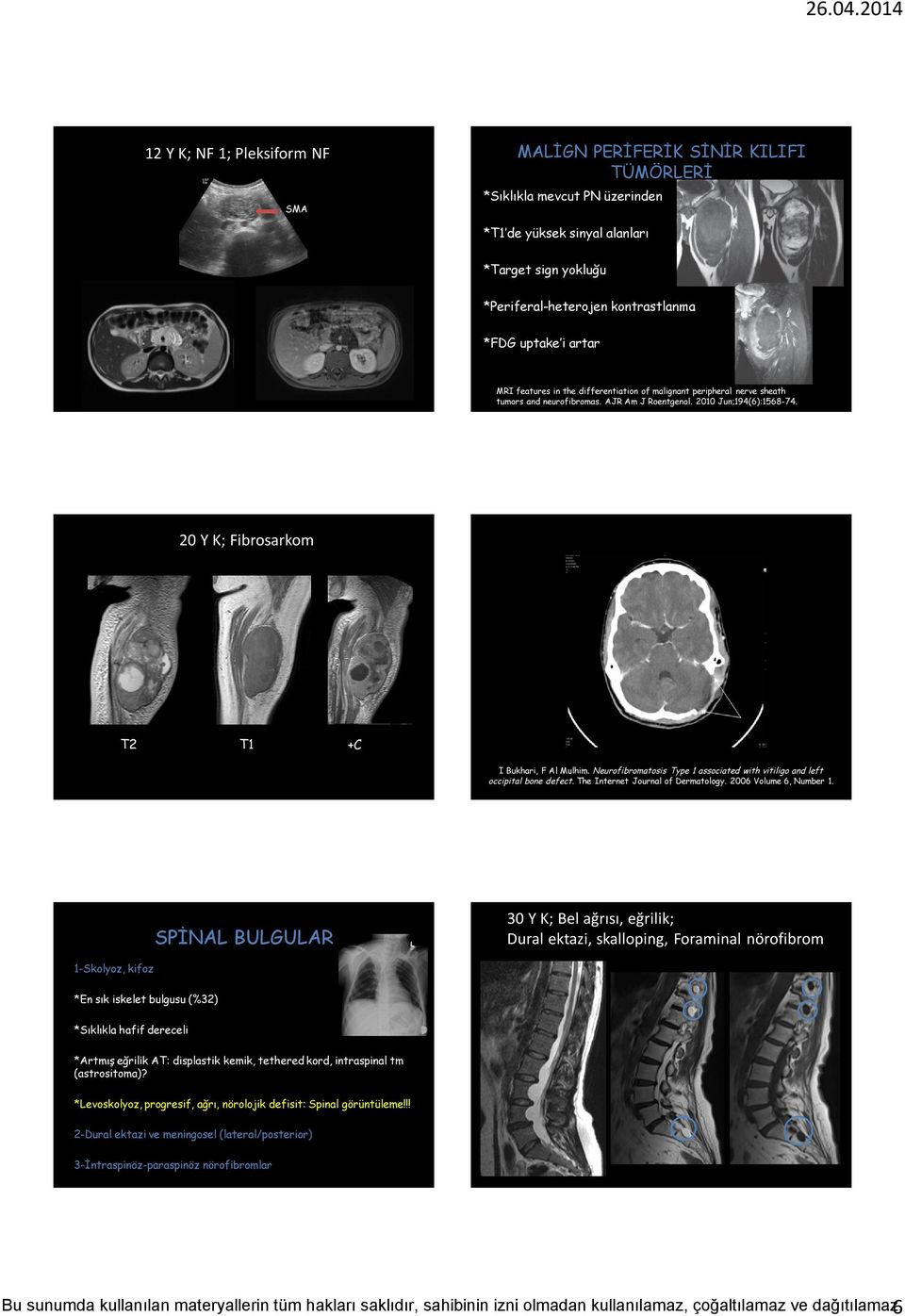 20 Y K; Fibrosarkom T2 T1 +C I Bukhari, F Al Mulhim. Neurofibromatosis Type 1 associated with vitiligo and left occipital bone defect. The Internet Journal of Dermatology. 2006 Volume 6, Number 1.