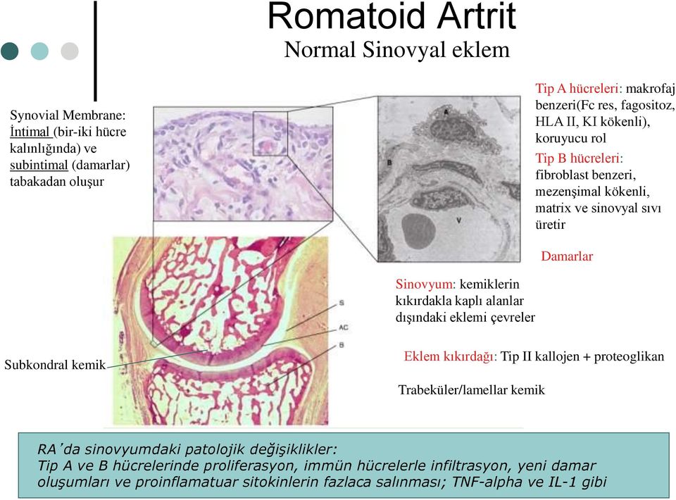 kıkırdakla kaplı alanlar dışındaki eklemi çevreler Subkondral kemik Eklem kıkırdağı: Tip II kallojen + proteoglikan Trabeküler/lamellar kemik RA da sinovyumdaki patolojik