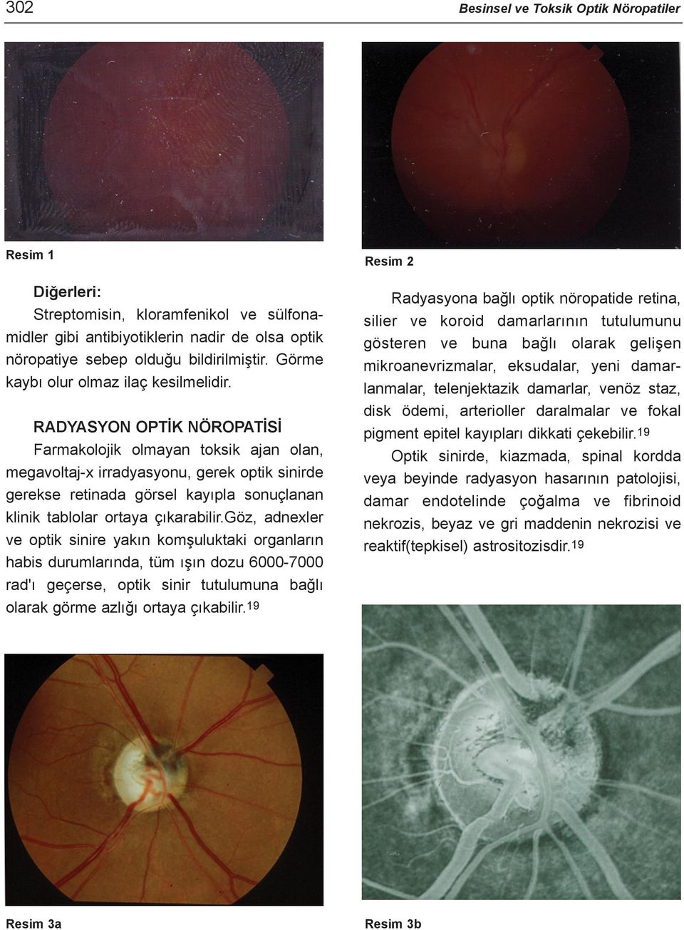 RADYASYON OPTÝK NÖROPATÝSÝ Farmakolojik olmayan toksik ajan olan, megavoltaj-x irradyasyonu, gerek optik sinirde gerekse retinada görsel kayýpla sonuçlanan klinik tablolar ortaya çýkarabilir.