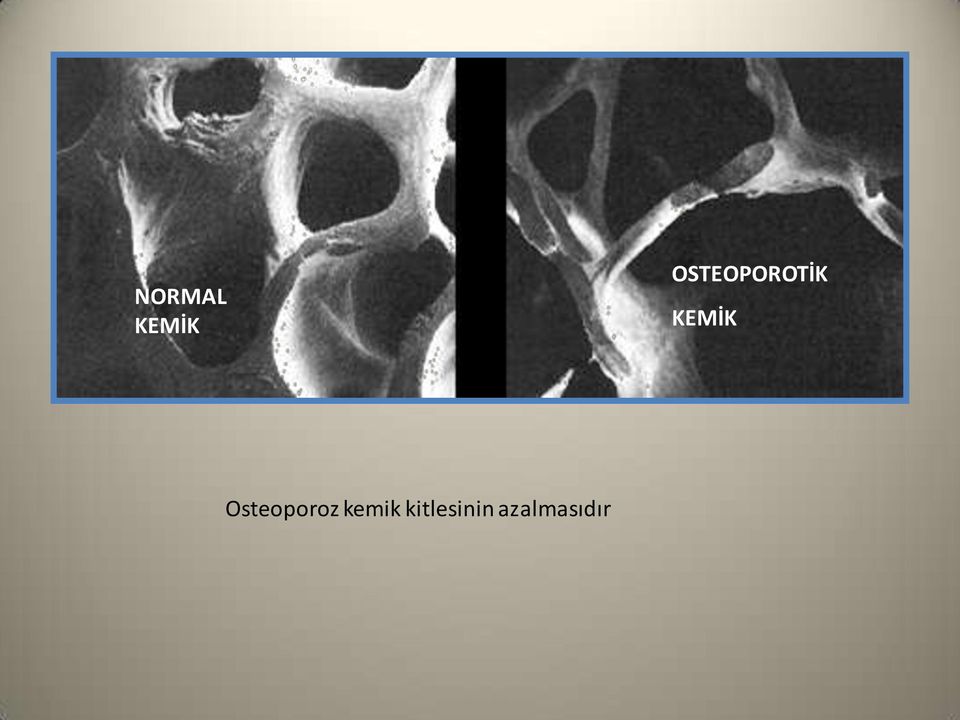 KEMİK Osteoporoz