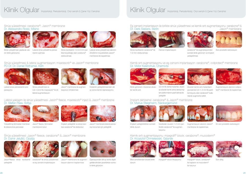 Derk Siebers, Berlin Jason membrane Sinüs yükseltmesi yapılacak alanın klinik görünümü Lateral sinüs yükseltme penceresinin açılması Sinüs kavitesinin 1,0-2,0 mm partikül büyüklüğü olan cerabone