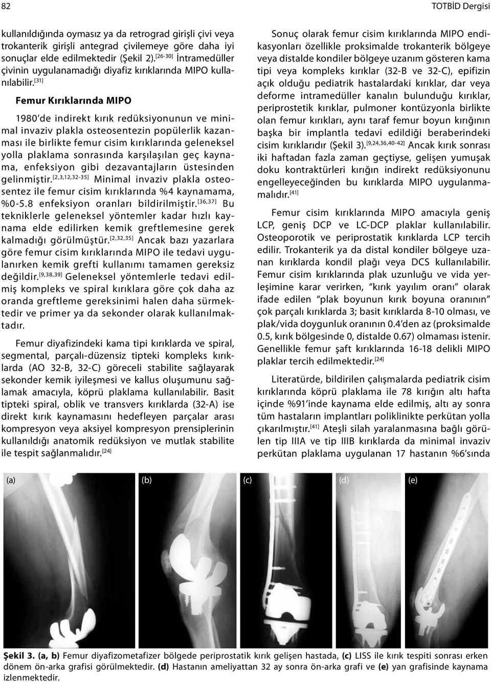 [31] Femur Kırıklarında MIPO 1980 de indirekt kırık redüksiyonunun ve minimal invaziv plakla osteosentezin popülerlik kazanması ile birlikte femur cisim kırıklarında geleneksel yolla plaklama