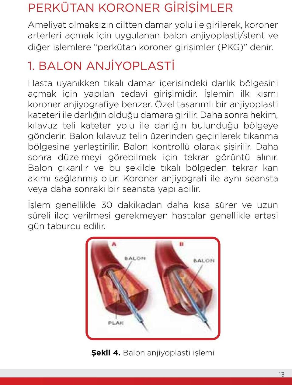 Özel tasarımlı bir anjiyoplasti kateteri ile darlığın olduğu damara girilir. Daha sonra hekim, kılavuz teli kateter yolu ile darlığın bulunduğu bölgeye gönderir.