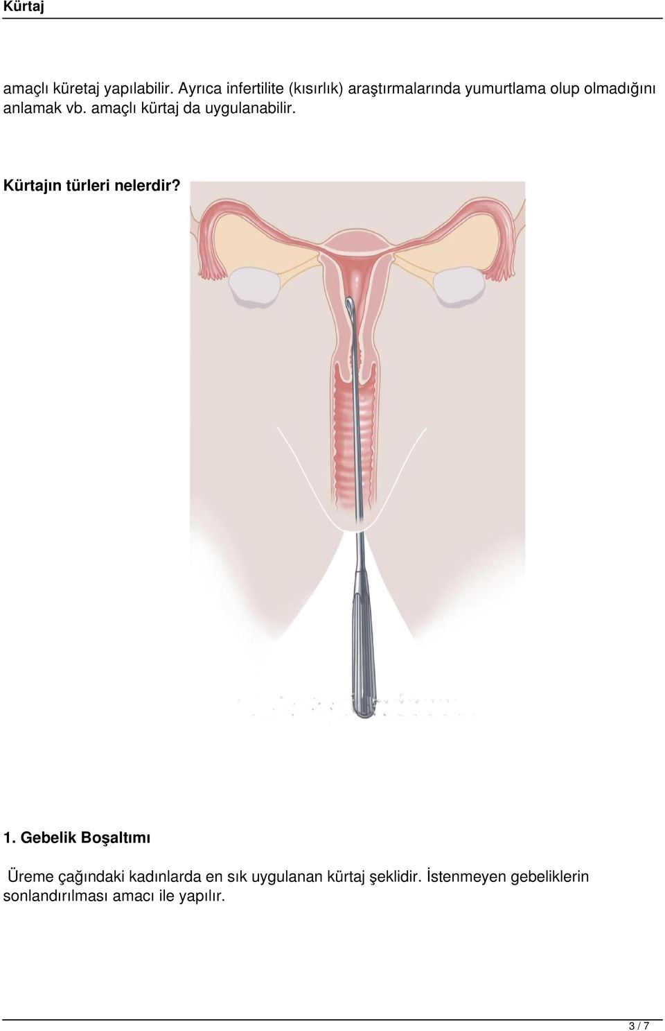 anlamak vb. amaçlı kürtaj da uygulanabilir. Kürtajın türleri nelerdir? 1.