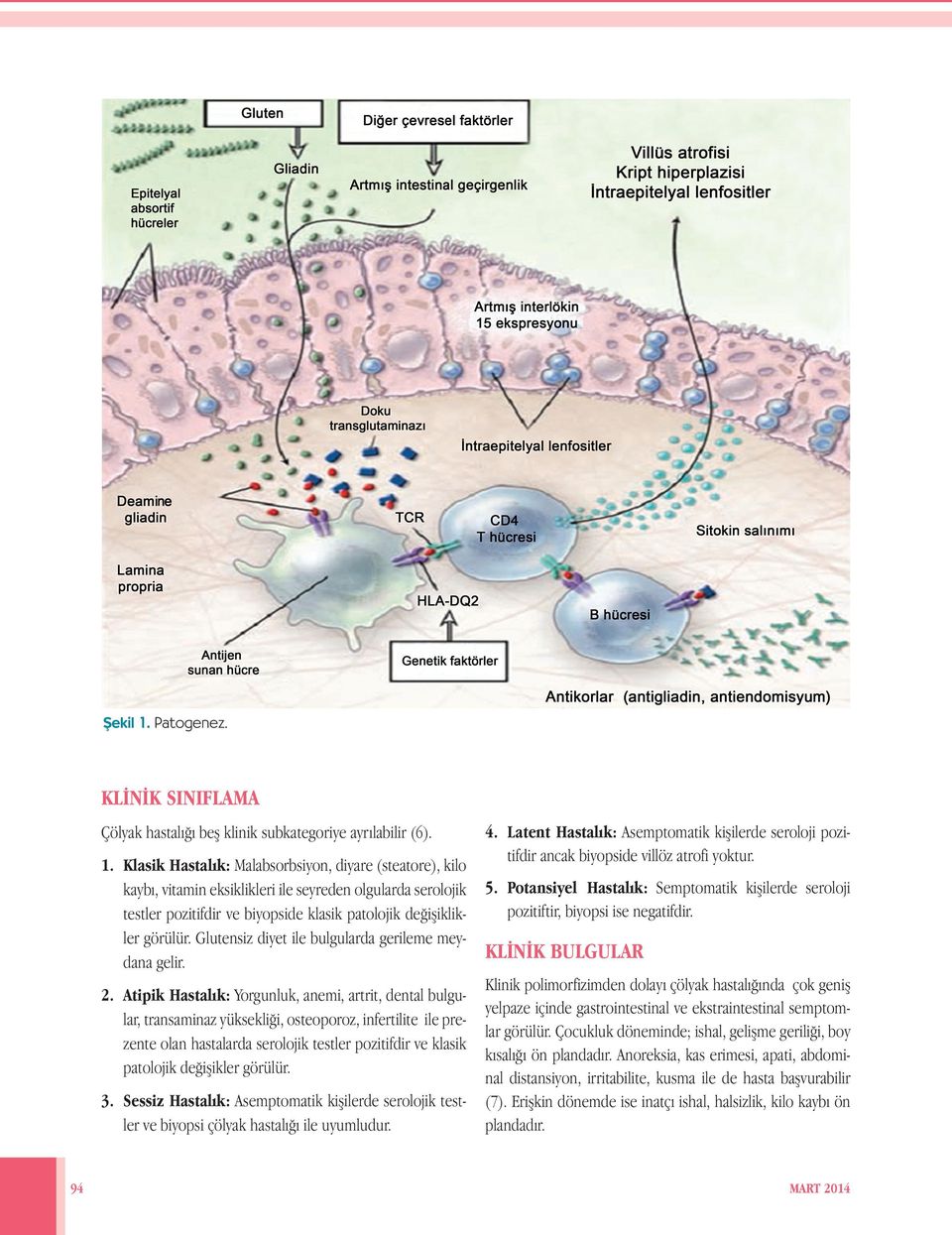 Atipik Hastalık: Yorgunluk, anemi, artrit, dental bulgular, transaminaz yüksekliği, osteoporoz, infertilite ile prezente olan hastalarda serolojik testler pozitifdir ve klasik patolojik değişikler