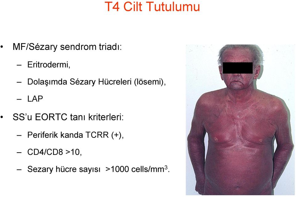 LAP SS u EORTC tanı kriterleri: Periferik kanda