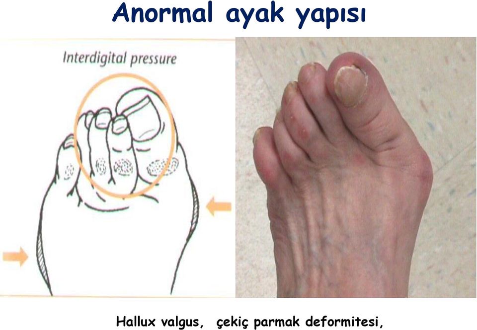 valgus, çekiç