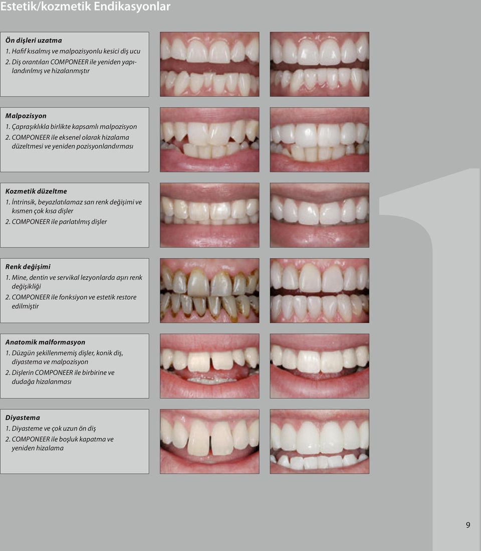 İntrinsik, beyazlatılamaz sarı renk değişimi ve kısmen çok kısa dişler 2. COMPONEER ile parlatılmış dişler Renk değişimi 1. Mine, dentin ve servikal lezyonlarda aşırı renk değişikliği 2.