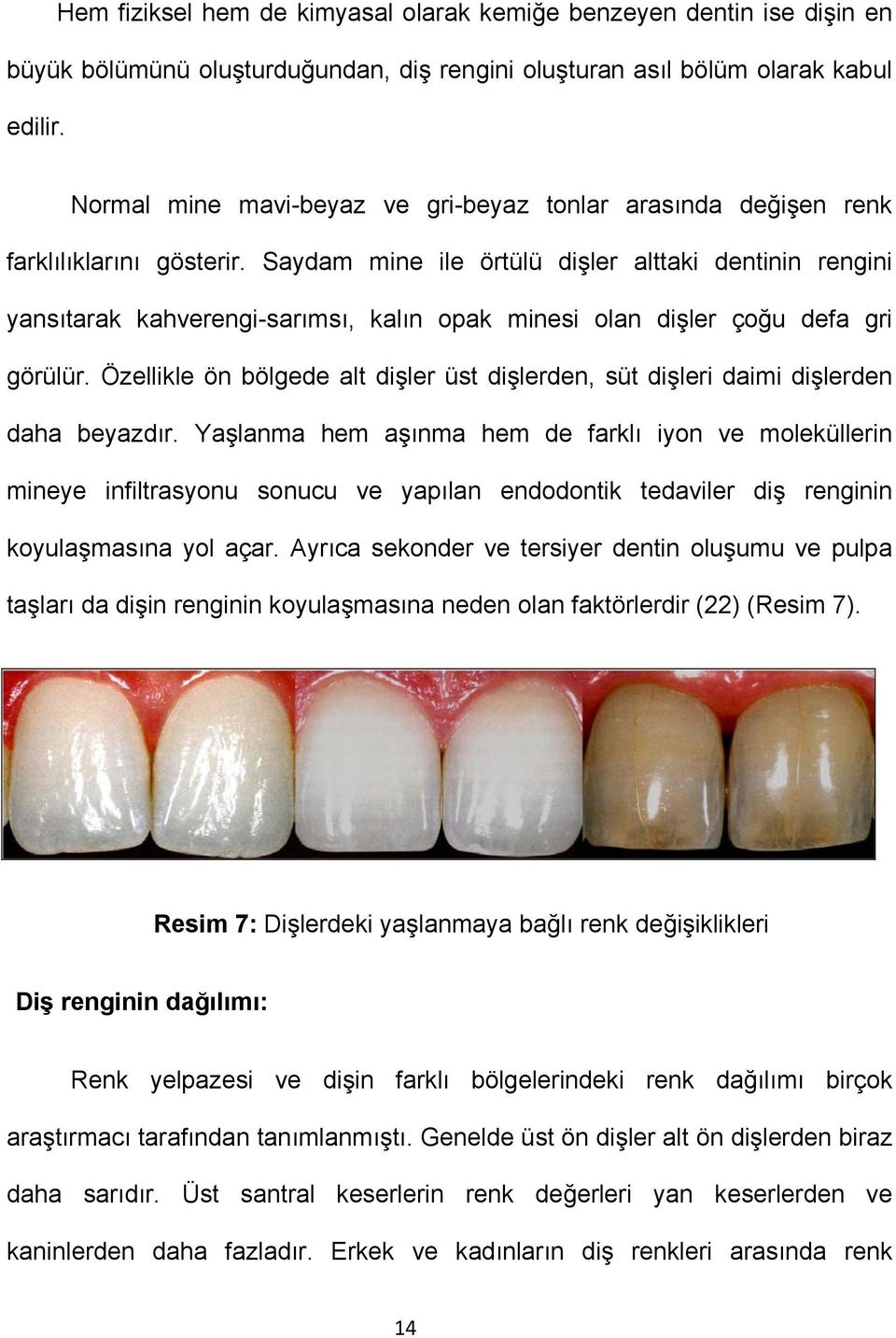 Saydam mine ile örtülü dişler alttaki dentinin rengini yansıtarak kahverengi-sarımsı, kalın opak minesi olan dişler çoğu defa gri görülür.