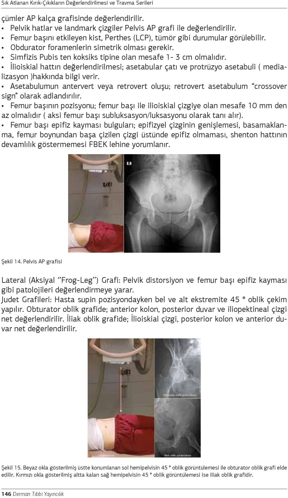 Simfizis Pubis ten koksiks tipine olan mesafe 1-3 cm olmalıdır. İlioiskial hattın değerlendirilmesi; asetabular çatı ve protrüzyo asetabuli ( medializasyon )hakkında bilgi verir.