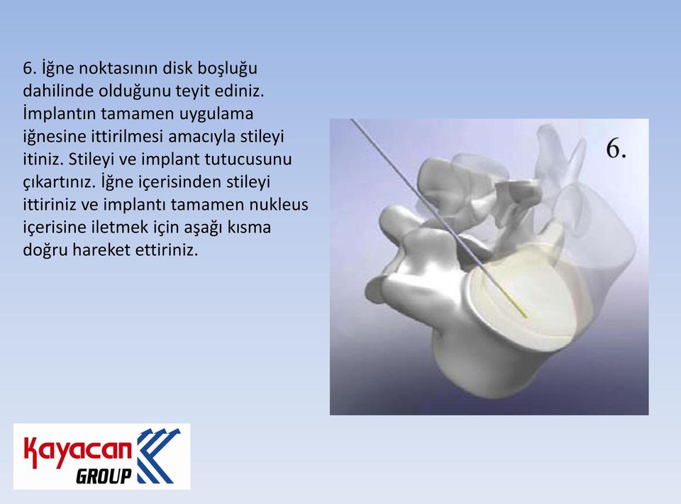 Stileyi ve implant tutucusunu çıkartınız.