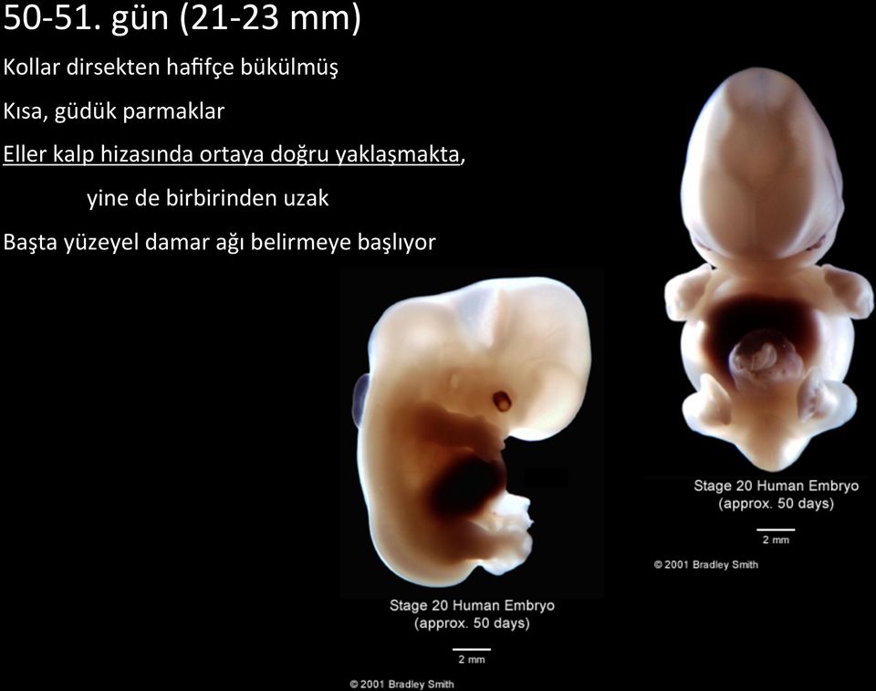 bükülmüş Kısa, güdük parmaklar Eller kalp