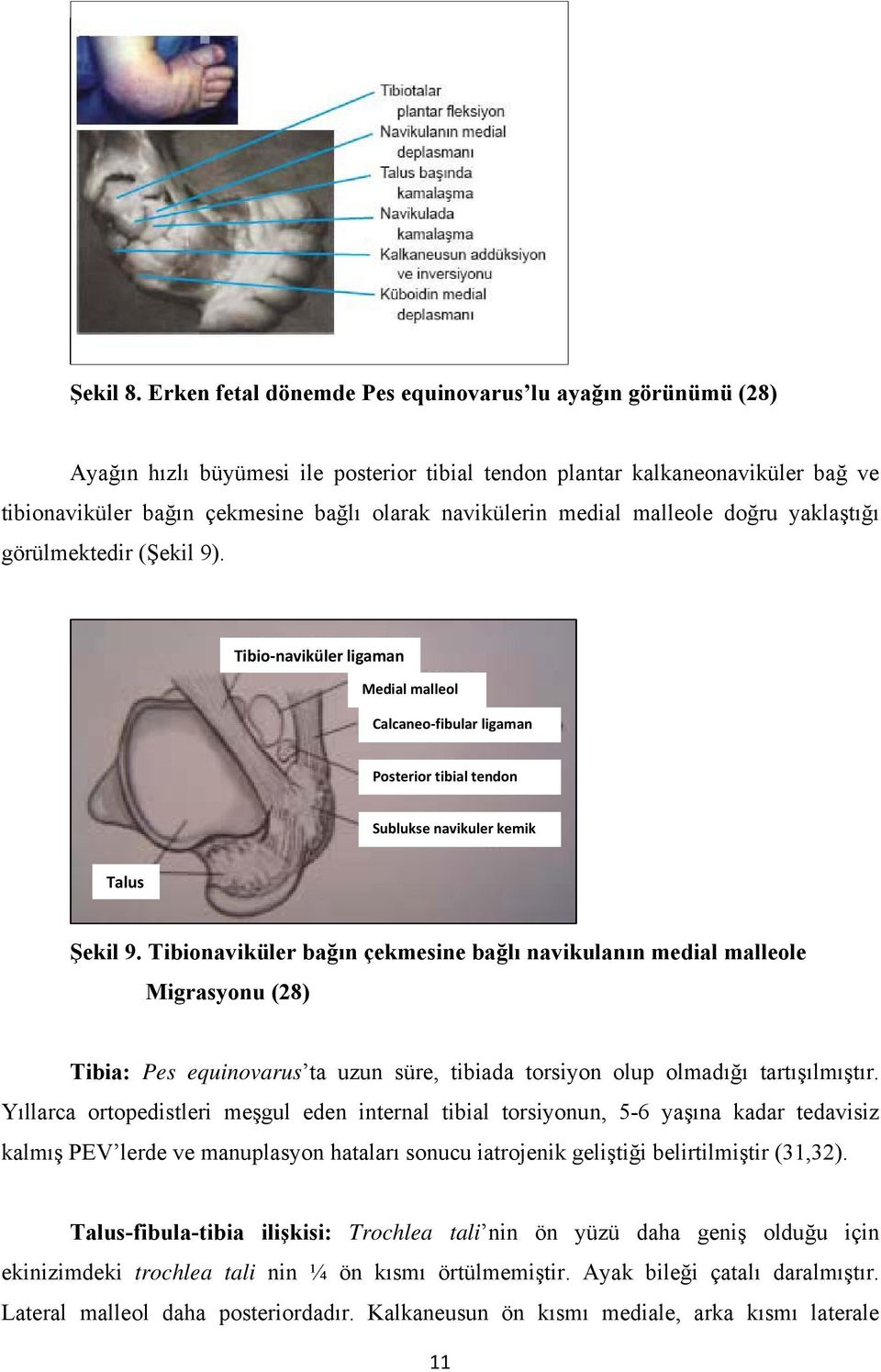 medial malleole doğru yaklaştığı görülmektedir (Şekil 9). Tibio naviküler ligaman Medial malleol Calcaneo fibular ligaman Posterior tibial tendon Sublukse navikuler kemik Talus Şekil 9.