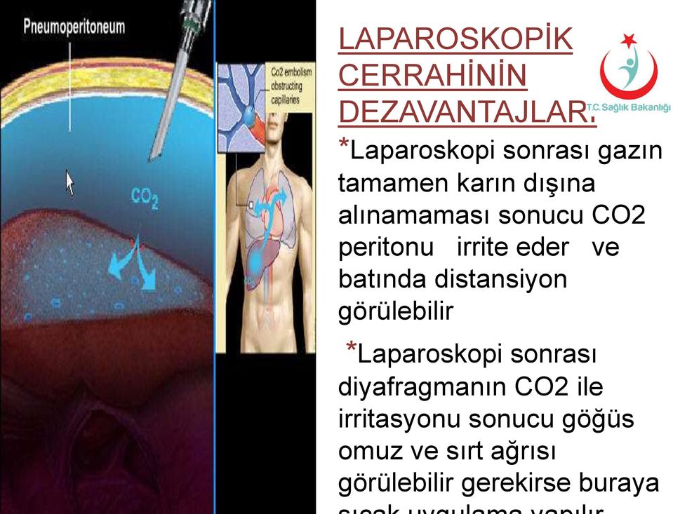 batında distansiyon görülebilir *Laparoskopi sonrası diyafragmanın CO2