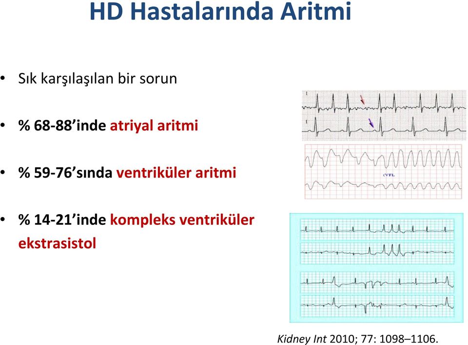 ventriküler aritmi % 14 21 inde kompleks