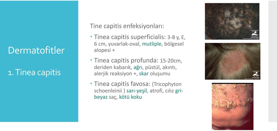 bölgesel alopesi + Tinea capitis profunda: 15-20cm, deriden kabarık, ağrı, püstül,