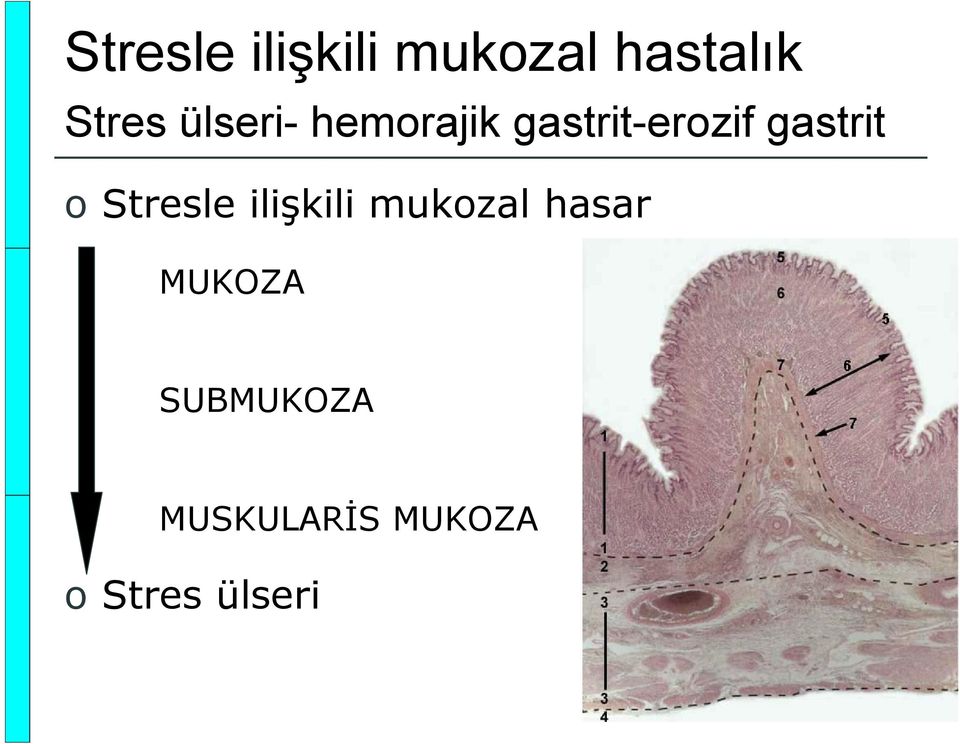 o Stresle ilişkili mukozal hasar MUKOZA