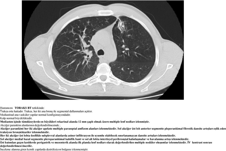Akciğer parankim alanlarının değerlendirilmesinde ; Akciğer parankimi her iki akciğer apekste multiple paraseptal amfizem alanları izlenmektedir.