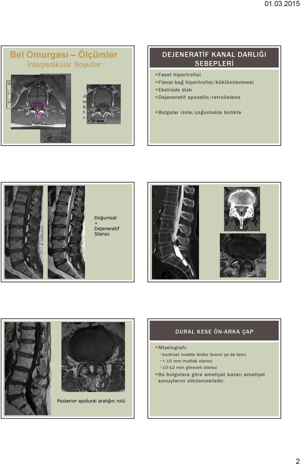 spondilo/retrolistezis Bulgular izole/çoğunlukla birlikte Doğumsal + Dejeneratif Stenoz DURAL KESE ÖN-ARKA ÇAP Miyelografi: kontrast madde bloku