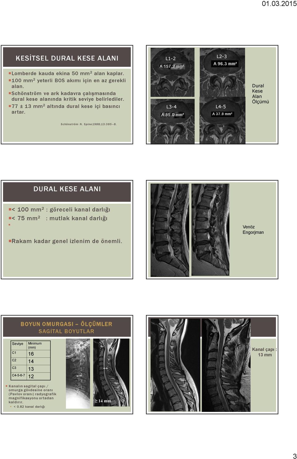 L3-4 L4-5 Dural Kese Alan Ölçümü Schönström N. Spine1988;13:3 85 8.