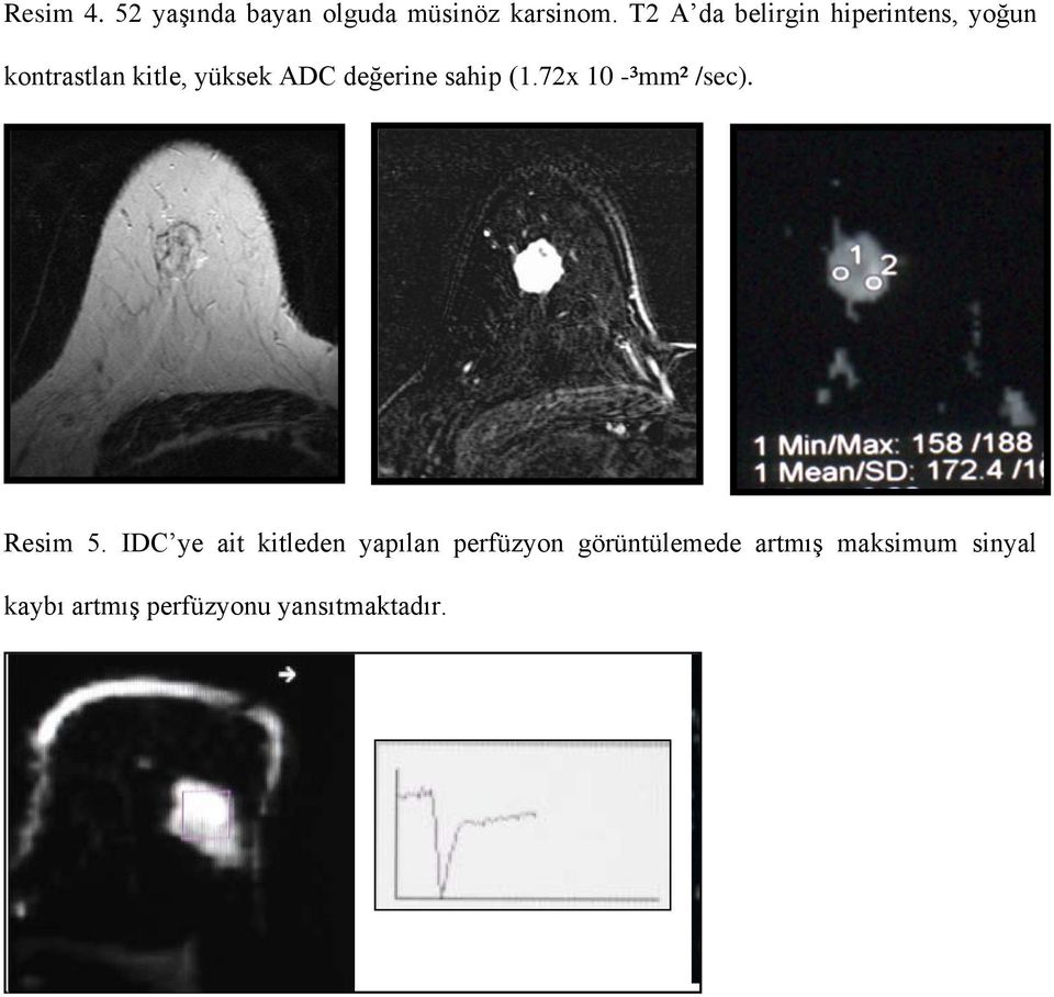 değerine sahip (1.72x 10 -³mm² /sec). Resim 5.