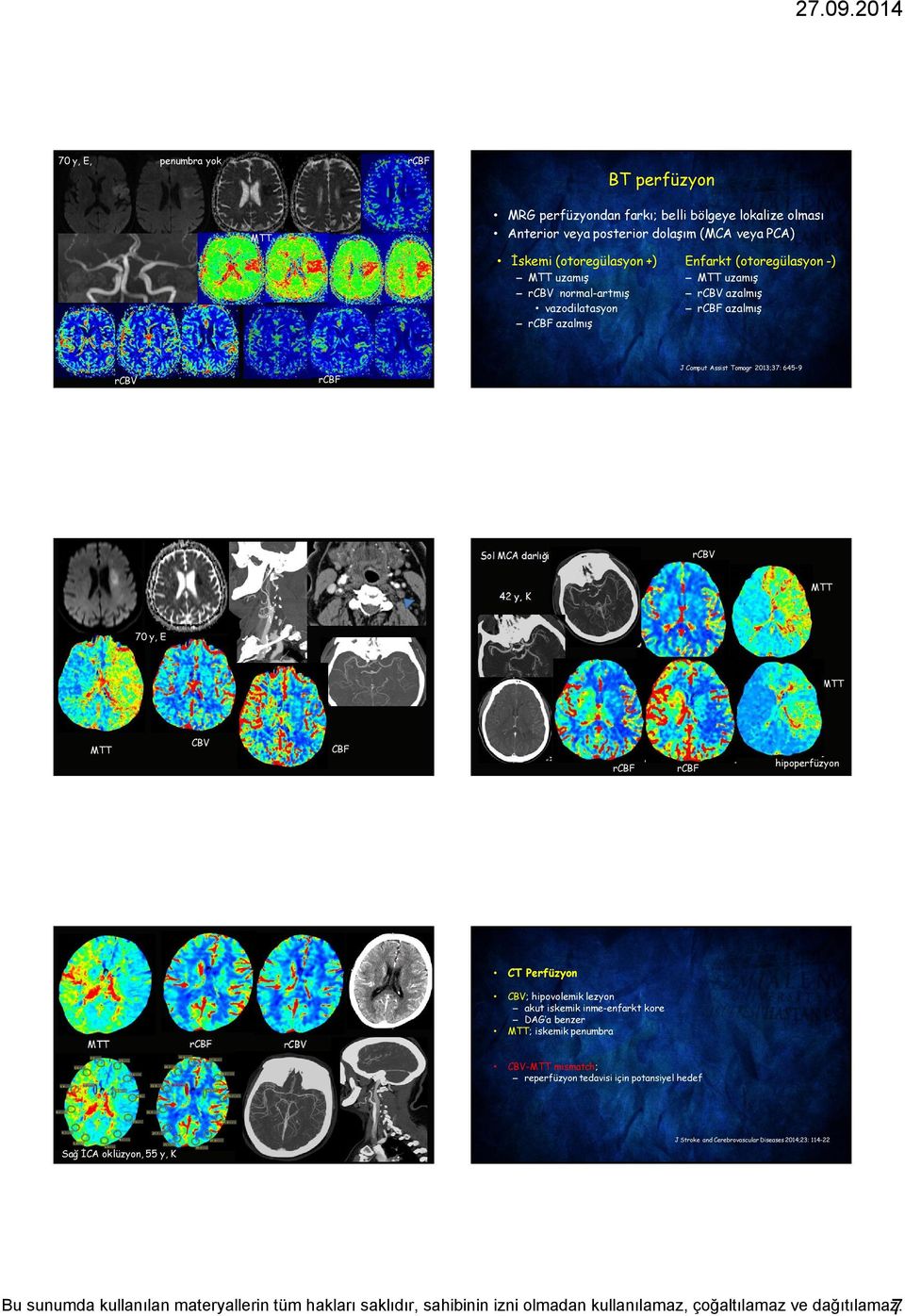 2013;37: 645 9 Sol MCA darlığı rcbv 42 y, K 70 y, E CBV CBF hipoperfüzyon CT Perfüzyon rcbv CBV; hipovolemik lezyon akut iskemik inme-enfarkt kore DAG a