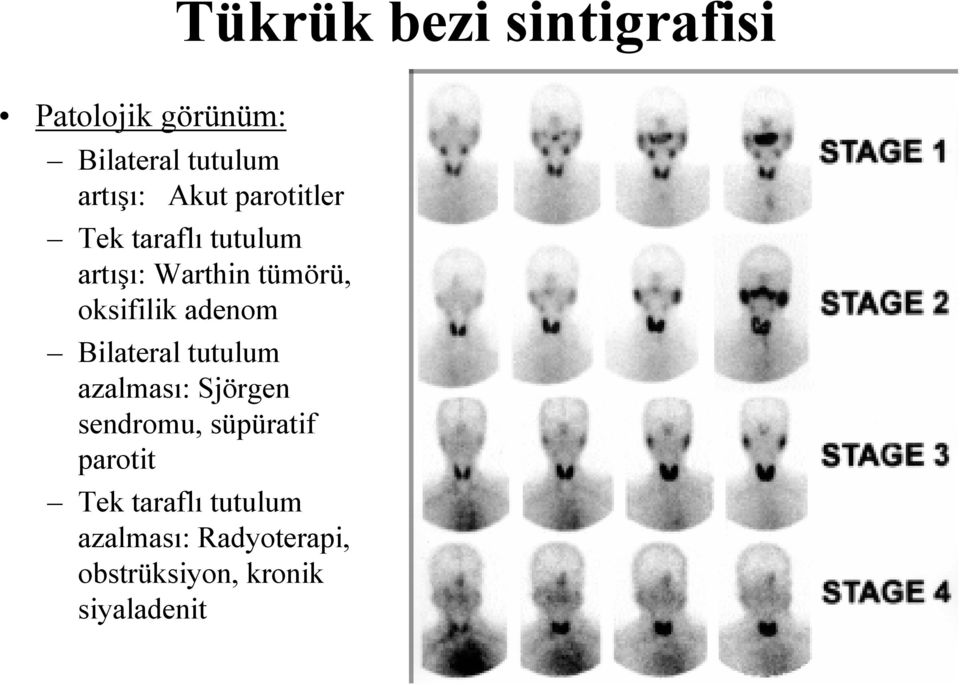 adenom Bilateral tutulum azalması: Sjörgen sendromu, süpüratif parotit