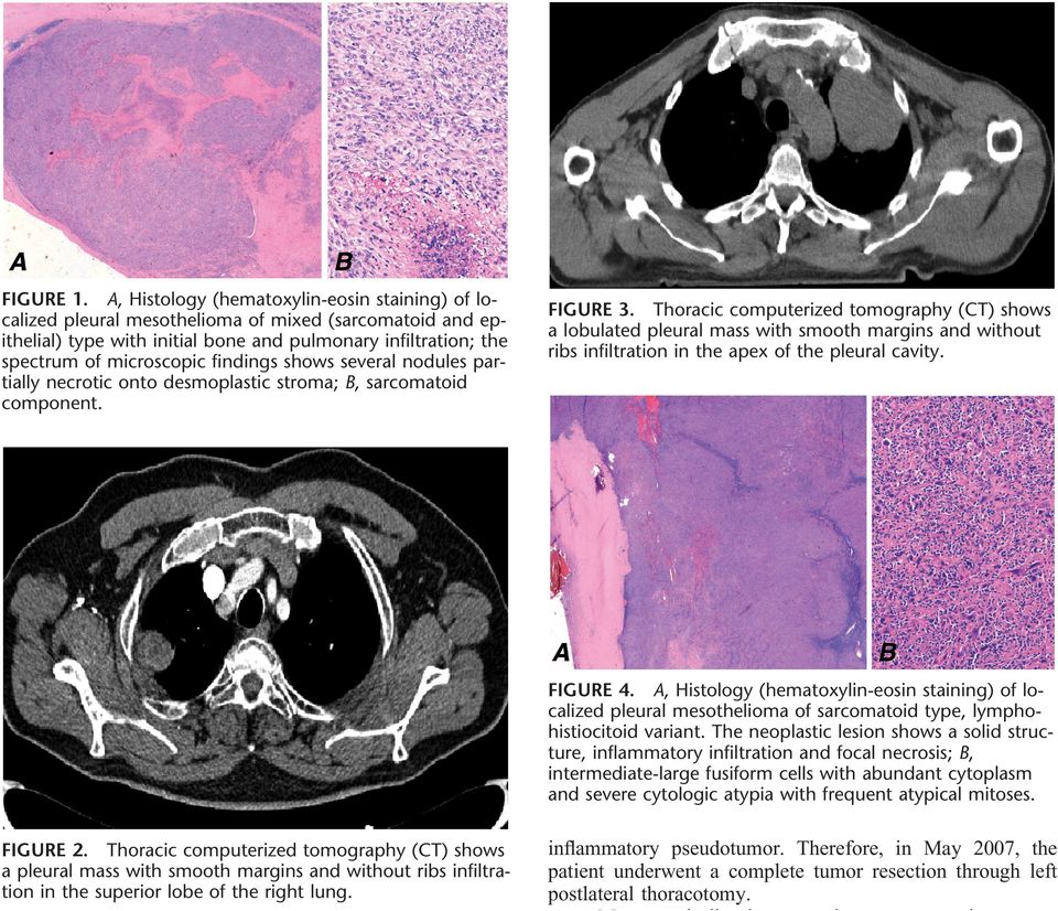 findings shows several nodules partially necrotic onto desmoplastic stroma; B, sarcomatoid component. FIGURE 3.