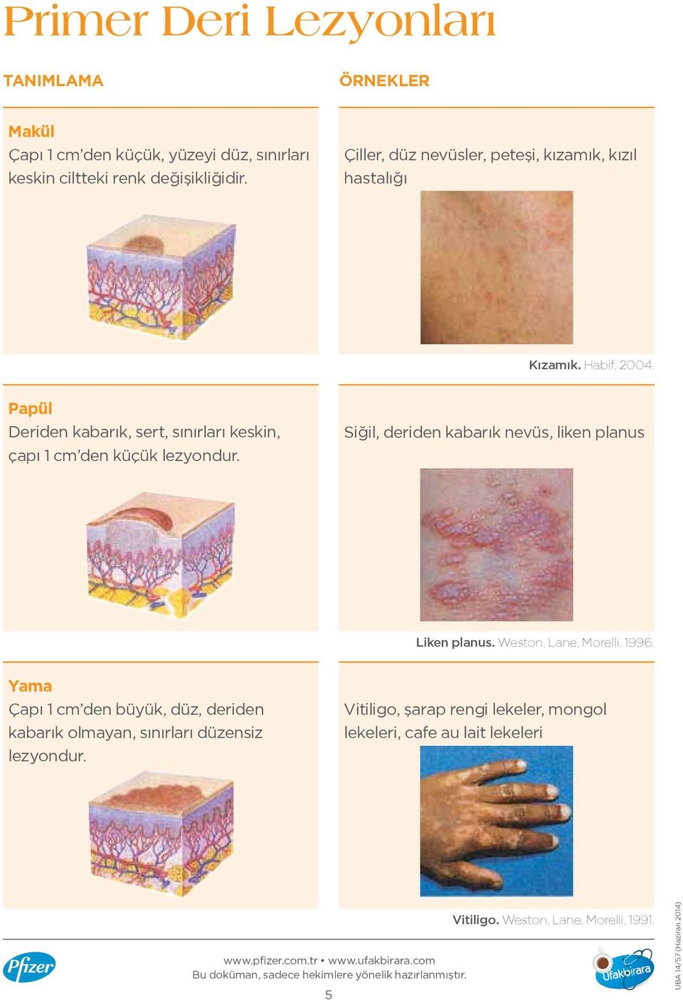 Papül Deriden kabarık, sert, sınırları keskin, çapı 1 cm den küçük lezyondur. Siğil, deriden kabarık nevüs, liken planus Liken planus.