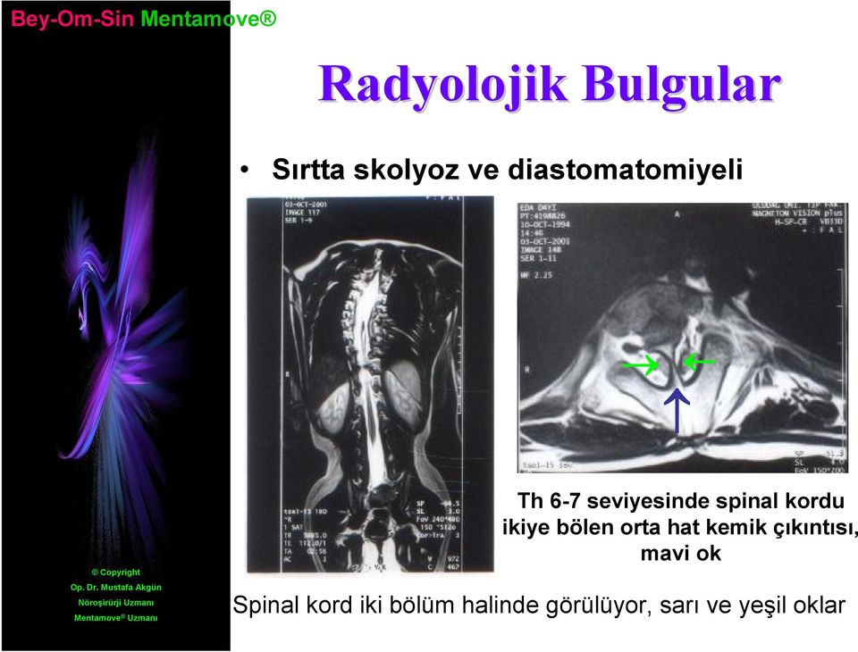 ikiye bölen orta hat kemik çıkıntısı, mavi ok