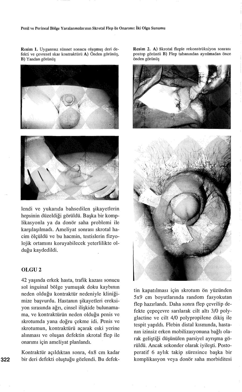 A) Skrotal fleple rekonstrüksiyon sonrası postop görüntü B) Flep tabanından ayrılmadan önce önden görünüş lendi ve yukarıda bahsedilen şikayetlerin hepsinin düzeldiği görüldü.