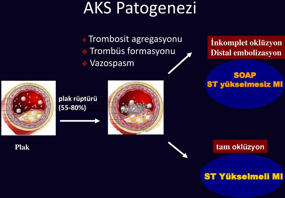 Distal embolizasyon SOAP ST yükselmesiz MI