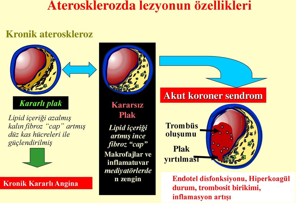 içeriği artmış ince fibroz cap Makrofajlar ve inflamatuvar mediyatörlerde n zengin Akut koroner