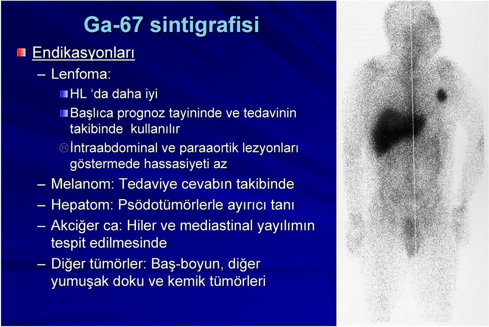 Tedaviye cevabın n takibinde Hepatom: Psödot dotümörlerle ayırıcı tanı Akciğer ca: Hiler ve