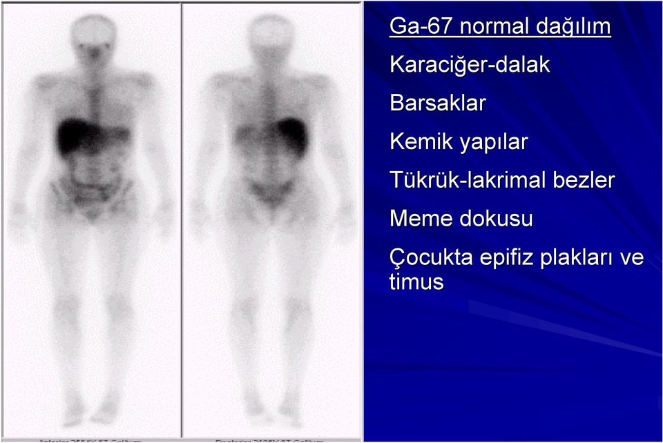 Tükrük-lakrimal bezler Meme