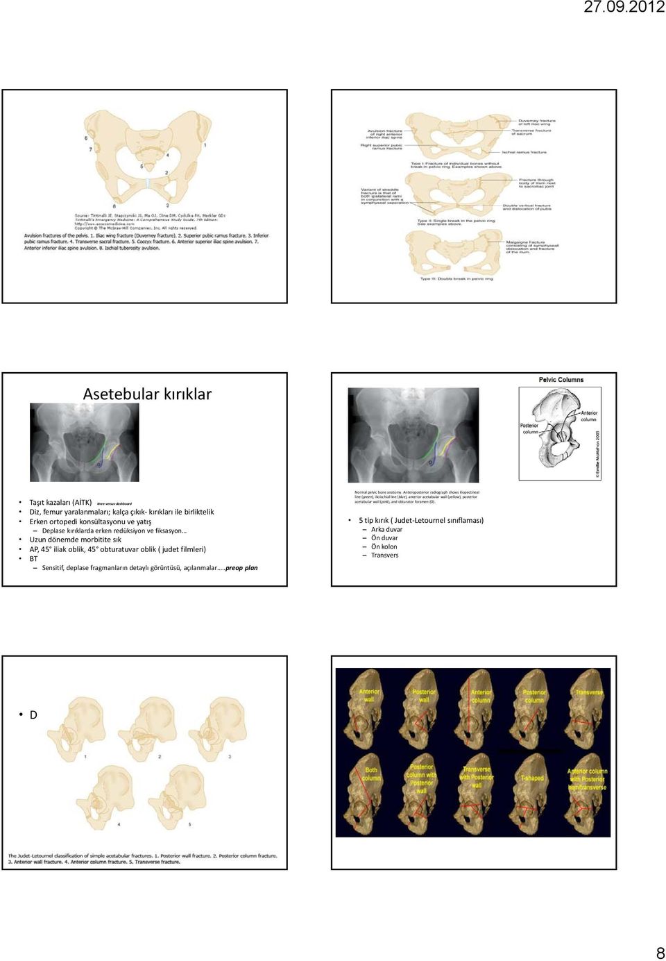 detaylı görüntüsü, açılanmalar..preop plan Normal pelvic bone anatomy.