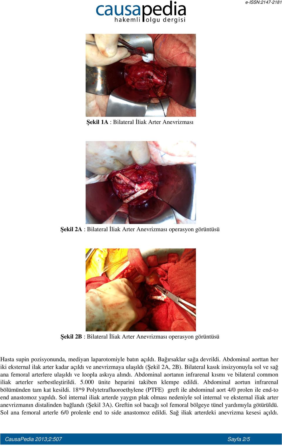 Bilateral kasık insizyonuyla sol ve sağ ana femoral arterlere ulaşıldı ve loopla askıya alındı. Abdominal aortanın infrarenal kısmı ve bilateral common iliak arterler serbestleştirildi. 5.