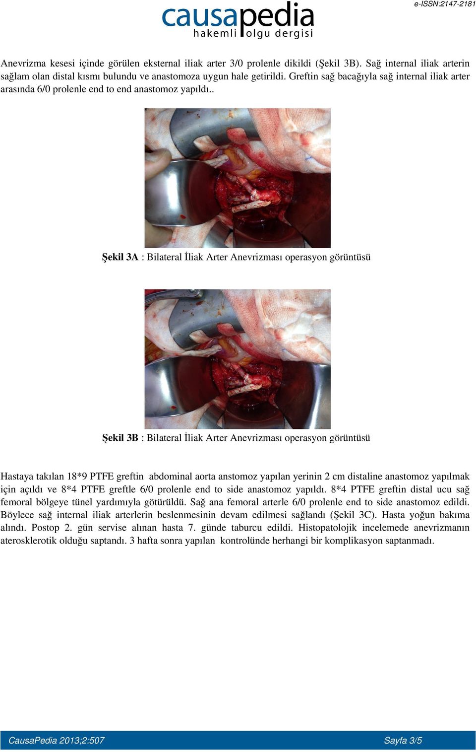 . Şekil 3A : Bilateral İliak Arter Anevrizması operasyon görüntüsü Şekil 3B : Bilateral İliak Arter Anevrizması operasyon görüntüsü Hastaya takılan 18*9 PTFE greftin abdominal aorta anstomoz yapılan