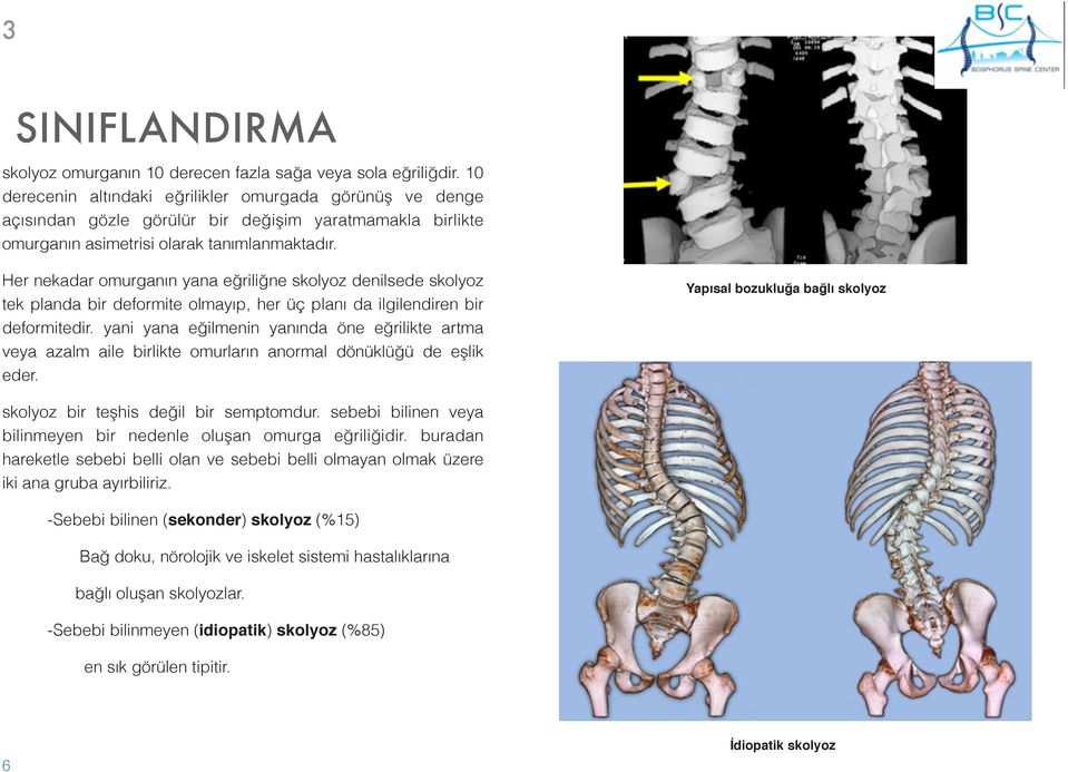 Her nekadar omurganın yana eğriliğne skolyoz denilsede skolyoz tek planda bir deformite olmayıp, her üç planı da ilgilendiren bir deformitedir.