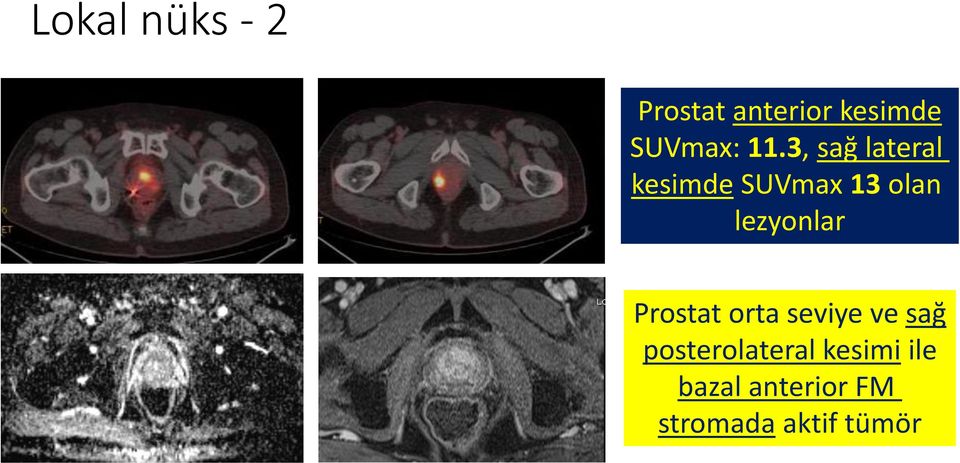 lezyonlar Prostat orta seviye ve sağ