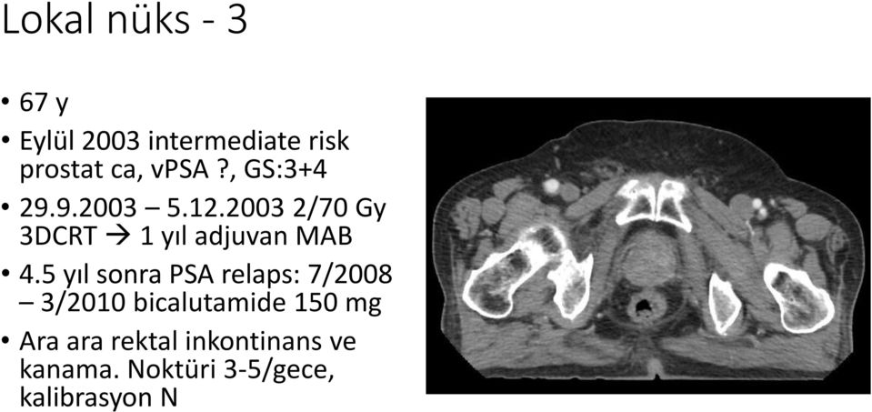 2003 2/70 Gy 3DCRT 1 yıl adjuvan MAB 4.