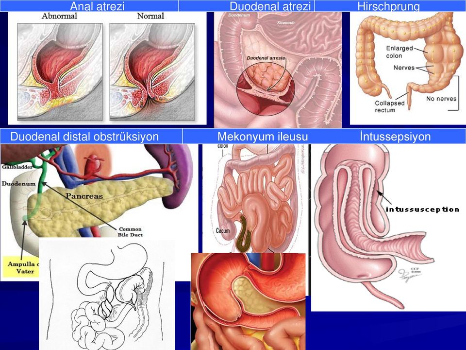 Duodenal distal