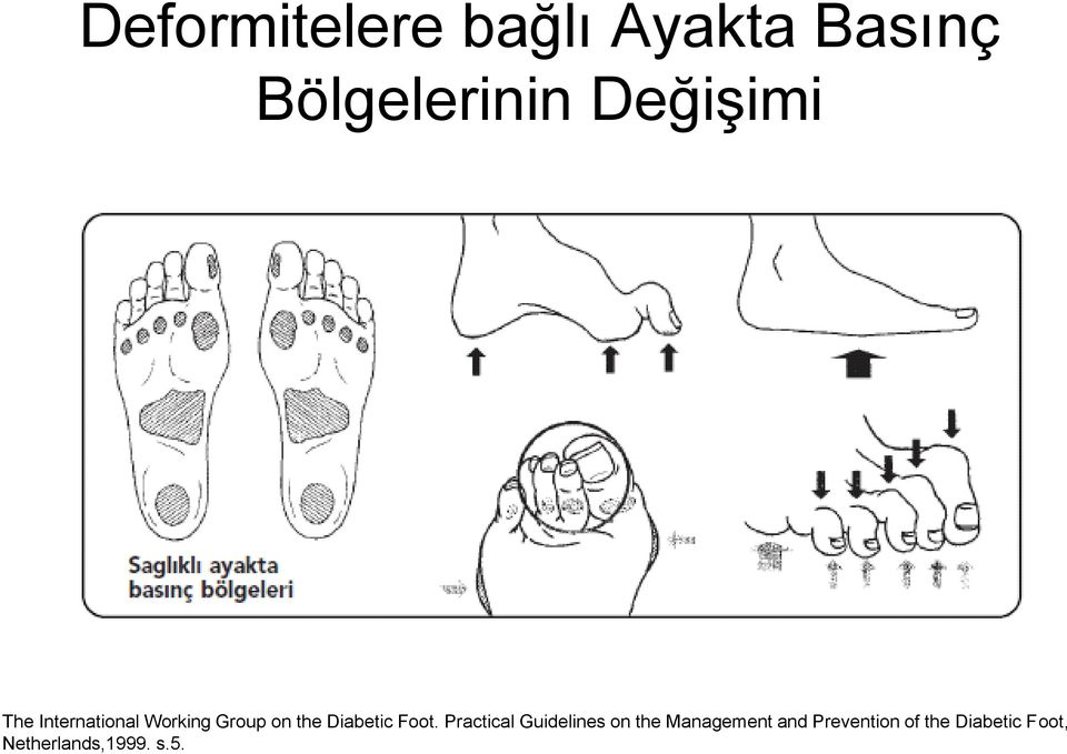 Diabetic Foot.